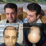 کلینیک تخصصی کاشت مو نیک سیما در تبریز