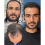 بهترین دکتر کاشت مو در قزوین ✨️ کلینیک زیبایی آرمو 💯 مرکز تخصصی کاشت ابرو و ریش در قزوین