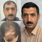 بهترین دکتر کاشت مو در قزوین ✨️ کلینیک زیبایی آرمو 💯 مرکز تخصصی کاشت ابرو و ریش در قزوین