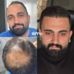 بهترین دکتر کاشت مو در قزوین ✨️ کلینیک زیبایی آرمو 💯 مرکز تخصصی کاشت ابرو و ریش در قزوین